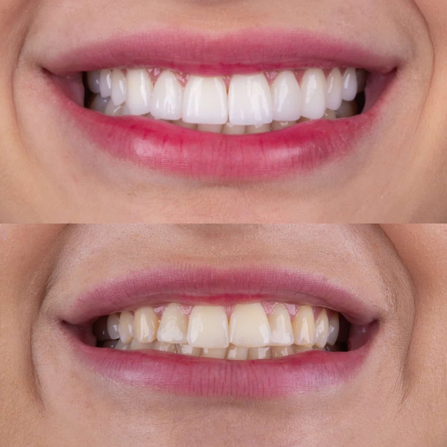 Facetas De Resina Estraga Os Dentes