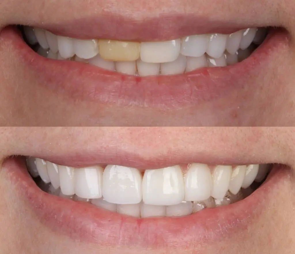 Implantes Dentários no Tatuapé - Allegra Odontologia