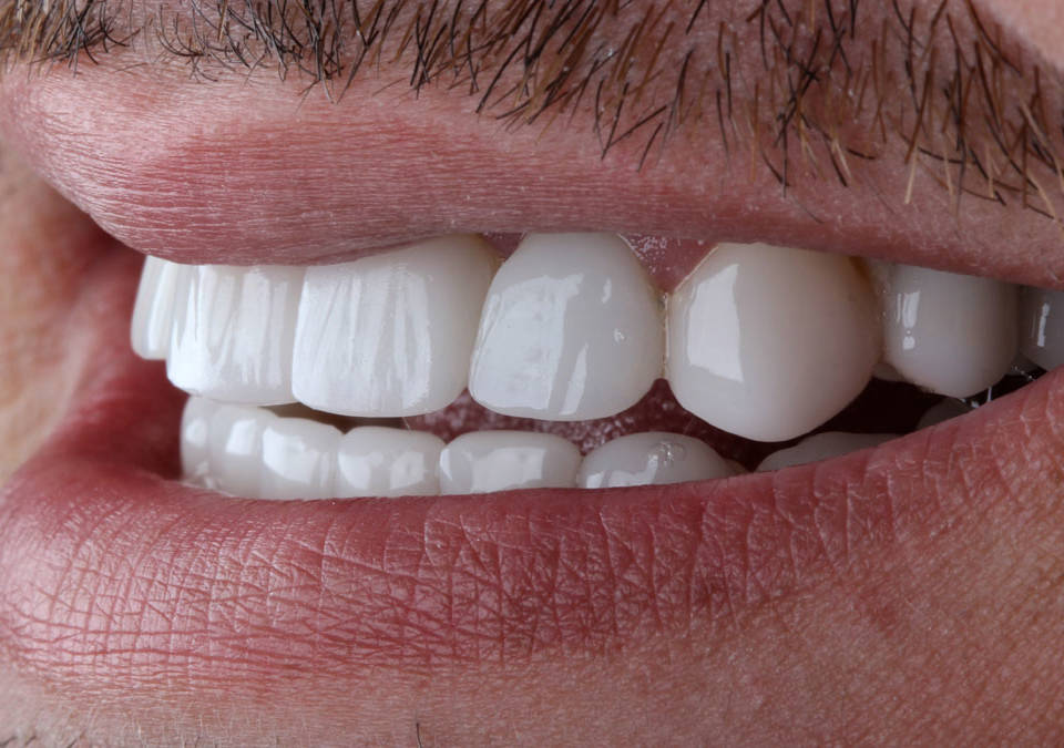 Coroa de porcelana dental no Tatuapé na Allegra Odontologia