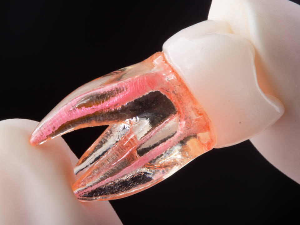 Tratamento de canal na Allegra Odontologia