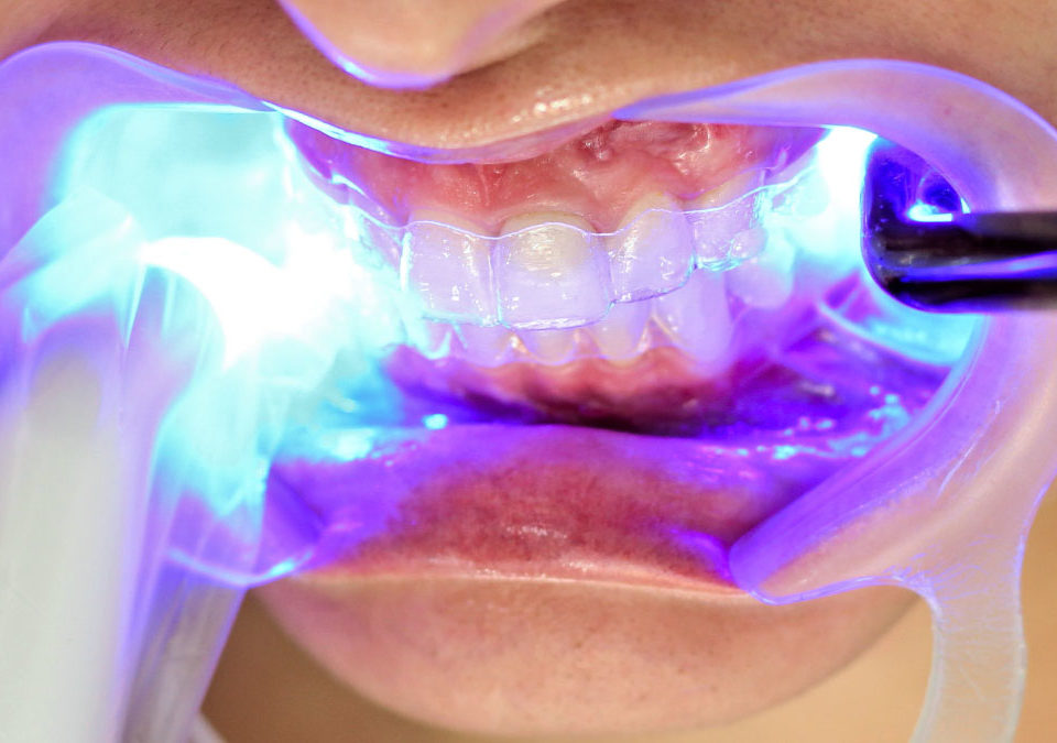 Aplicação do Laser para realizar o clareamento dentário na Allegra Odontologia