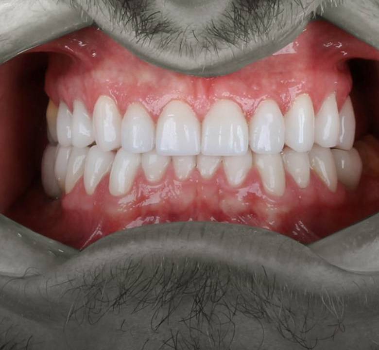 Lentes de porcelana na Allegra Odontologia