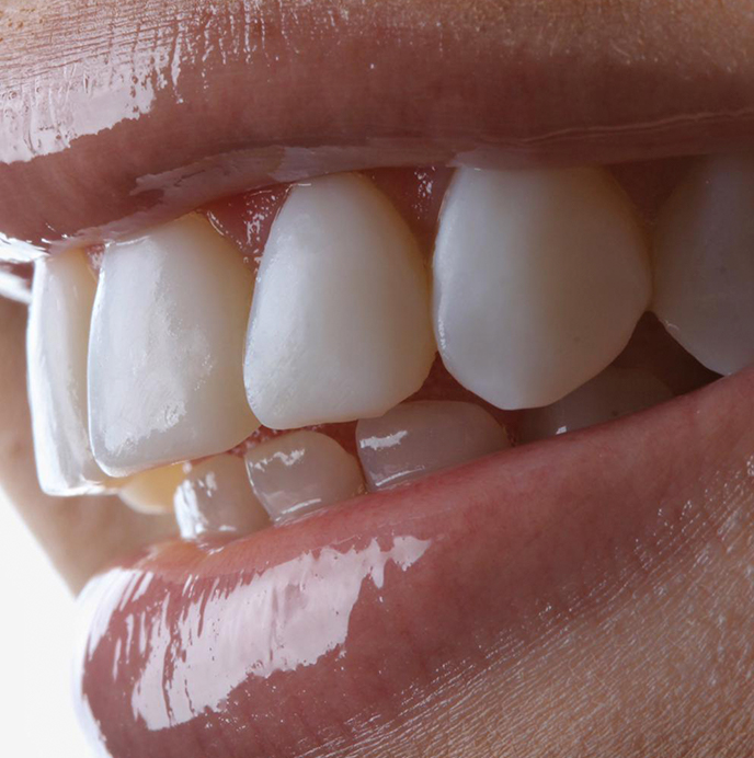 facetas de resina na Allegra Odontologia