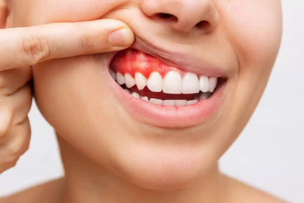 Foto de boca de paciente com gengivite sendo necessario passar no periodontista para fazer limpeza nos dentes na Allegra Odontologia