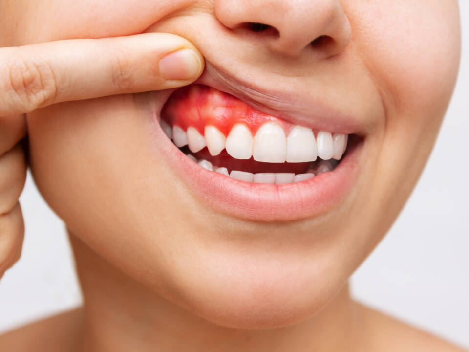 Foto de boca de paciente com gengivite sendo necessario passar no periodontista para fazer limpeza nos dentes na Allegra Odontologia