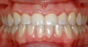 Quantos mm pode ser retirado de gengiva  - Allegra Odontologia?
