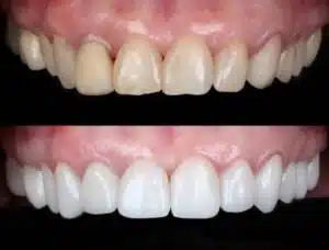 lentes de contato dental ou Facetas de porcelana na Allegra Odontologia