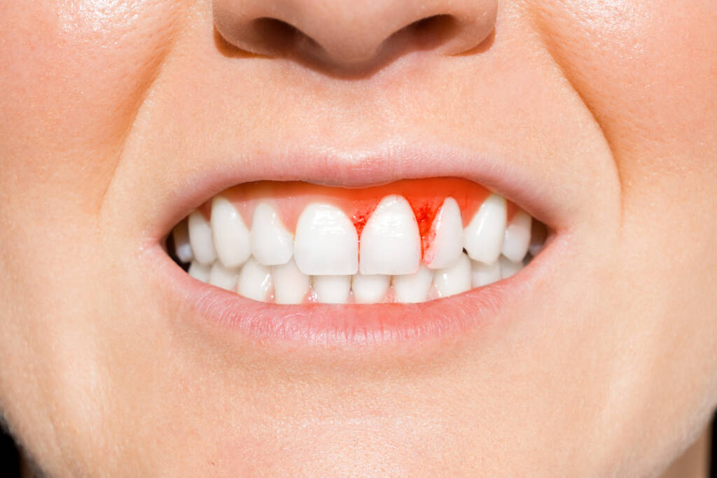 Foto de gengiva inflamada e sangrando que precisa de um tratamento periodontal na Allegra Odontologia