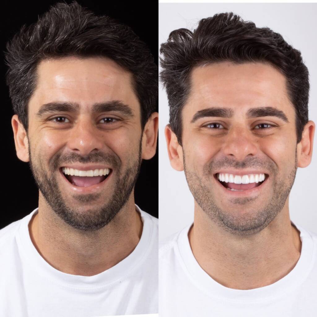 Lente de contato dental: foto de antes e depois