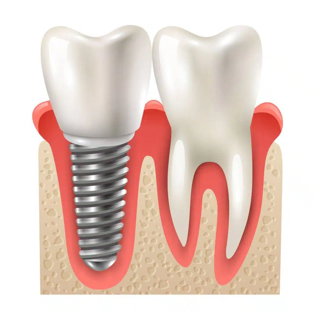 Peças do implante dentário 