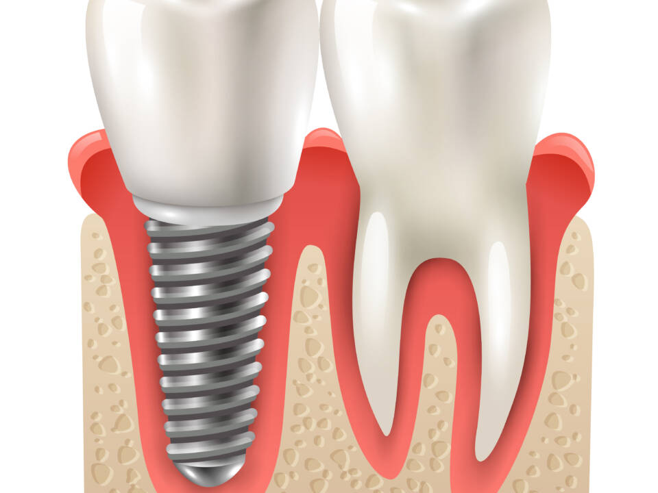 Existe idade mínima para fazer um implante no dente?