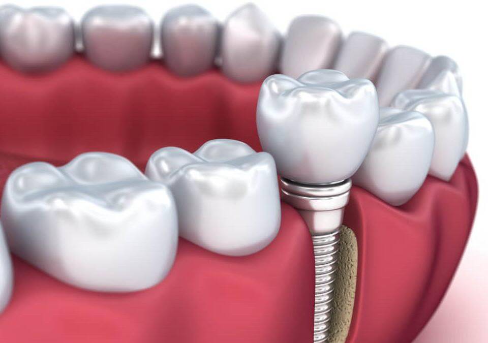 Quanto tempo dura um implante dental?