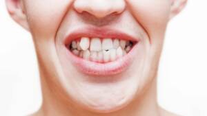 É possível corrigir dentes tortos sem usar aparelho ortodôntico?