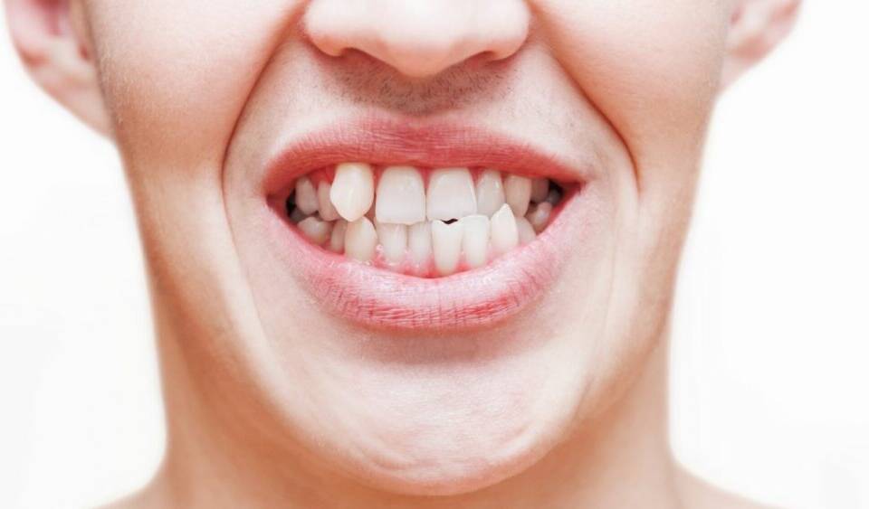 É possível corrigir dentes tortos sem usar aparelho ortodôntico?