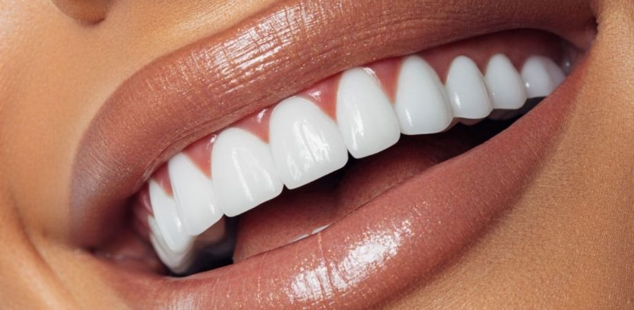 Clareamento Dental na Allegra Odontologia
