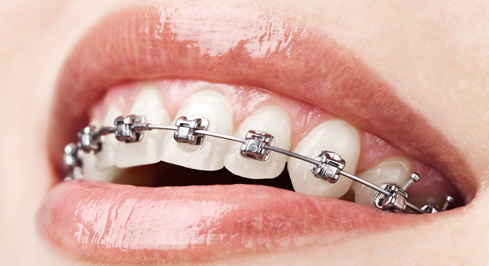 Ortodontia com aparelho Fixo metálico na Allegra Odontologia