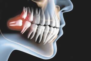 Dentes do siso inflamado - Allegra odontologia