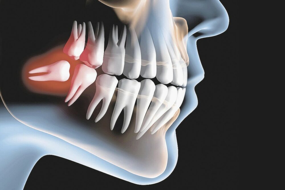 Extração de Dente do siso em SP - Allegra odontologia