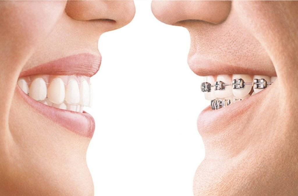 Alinhadores transparentes x Aparelhos fixos - Allegra Odontologia