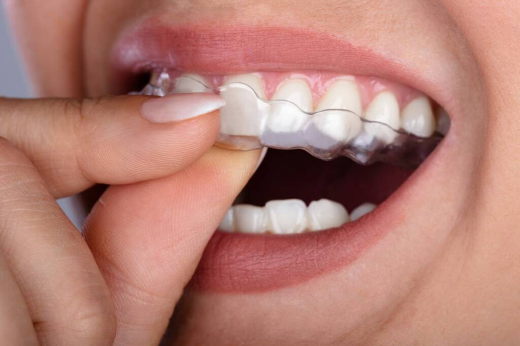 Clareamento caseiro na Allegra Odontologia