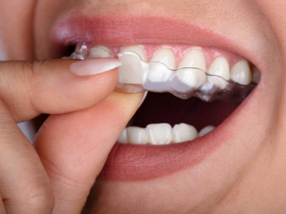 Alinhadores transparentes na Allegra Odontologia