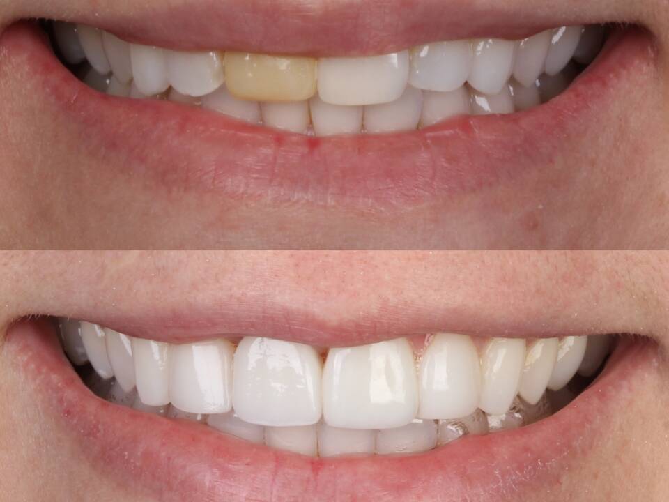 foto da boca de implante unitario com uma coroa dentária na Allegra