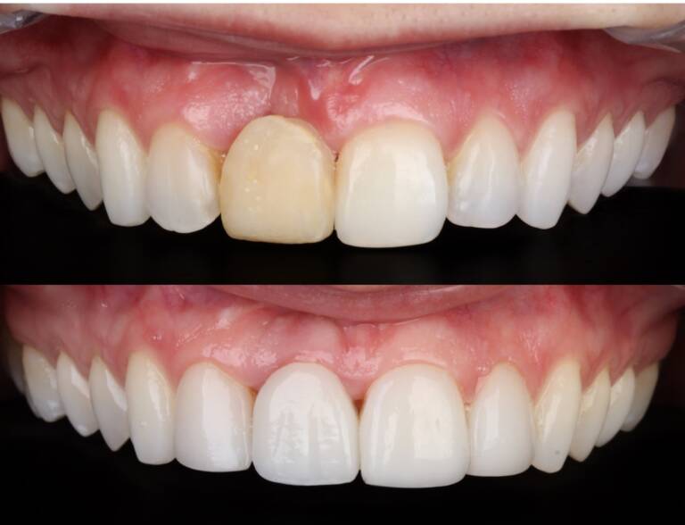 Implante dentário na Allegra Odontologia