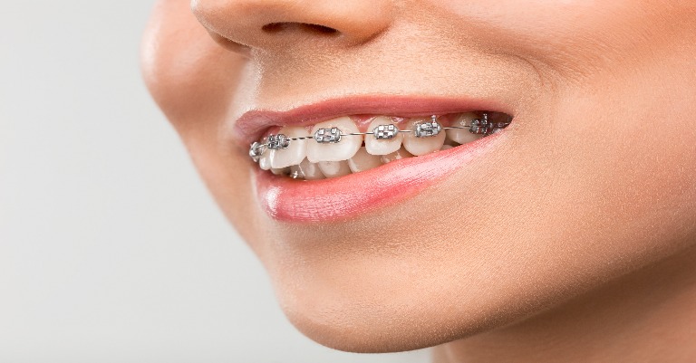 Ortodontia na Allegra Odontologia