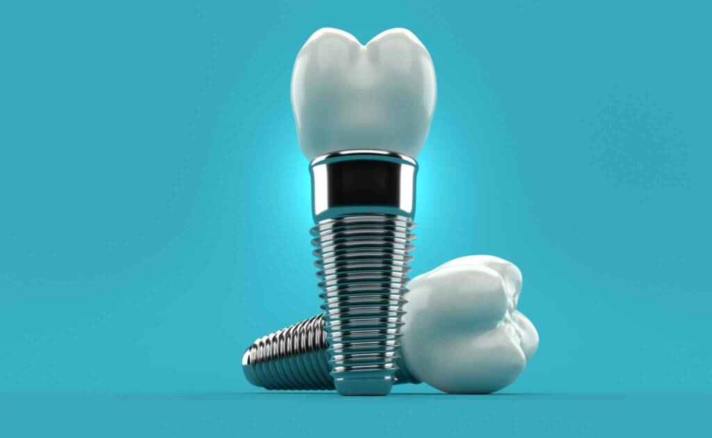 implantes dentarios Allegra ODONTOLOGIA