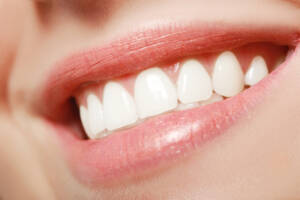 Clareamento dental na Allegra Odontologia