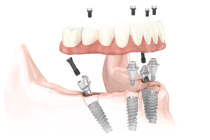 Carga imediata ou protocolo dentário na Allegra Odontologia
