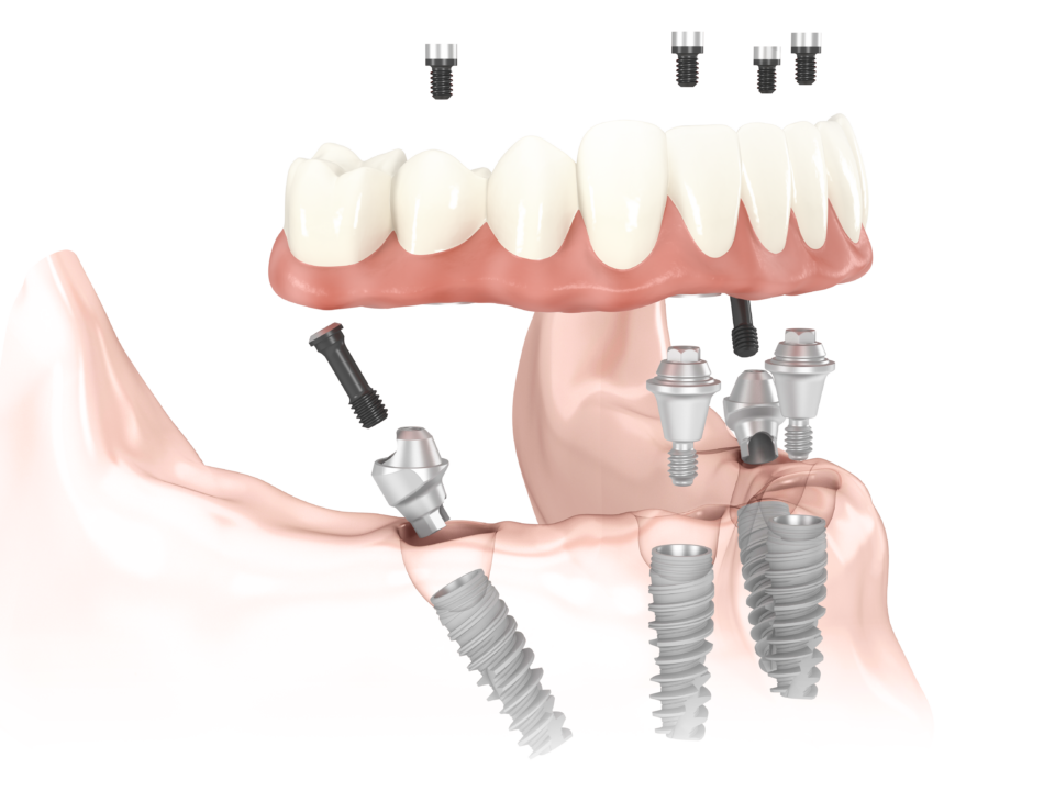 Carga imediata ou protocolo dentário na Allegra Odontologia