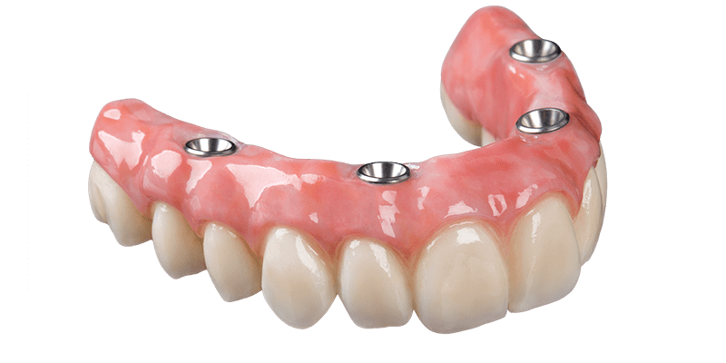 Prótese protocolo na Allegra Odontologia