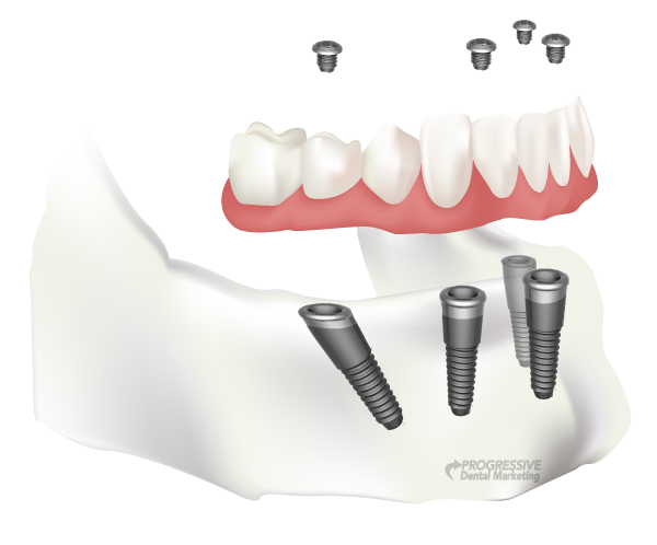 Protocolo dentário na Allegra Odontologia