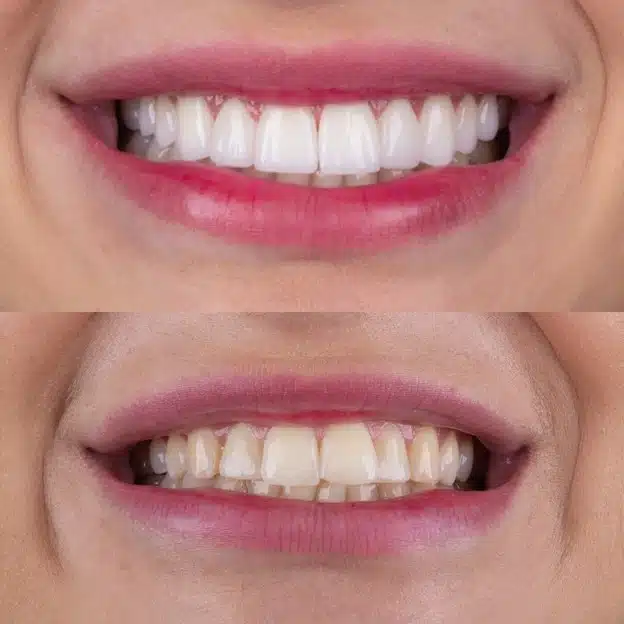 Clareamento Dental ou Facetas de Porcelana?