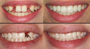 Implantes dentários na Allegra Odontologia