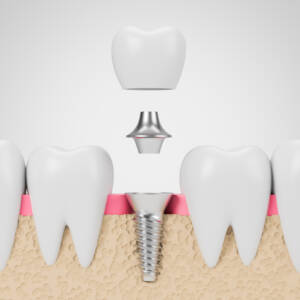 Dentes fixados no osso na Allegra Odontologia 9