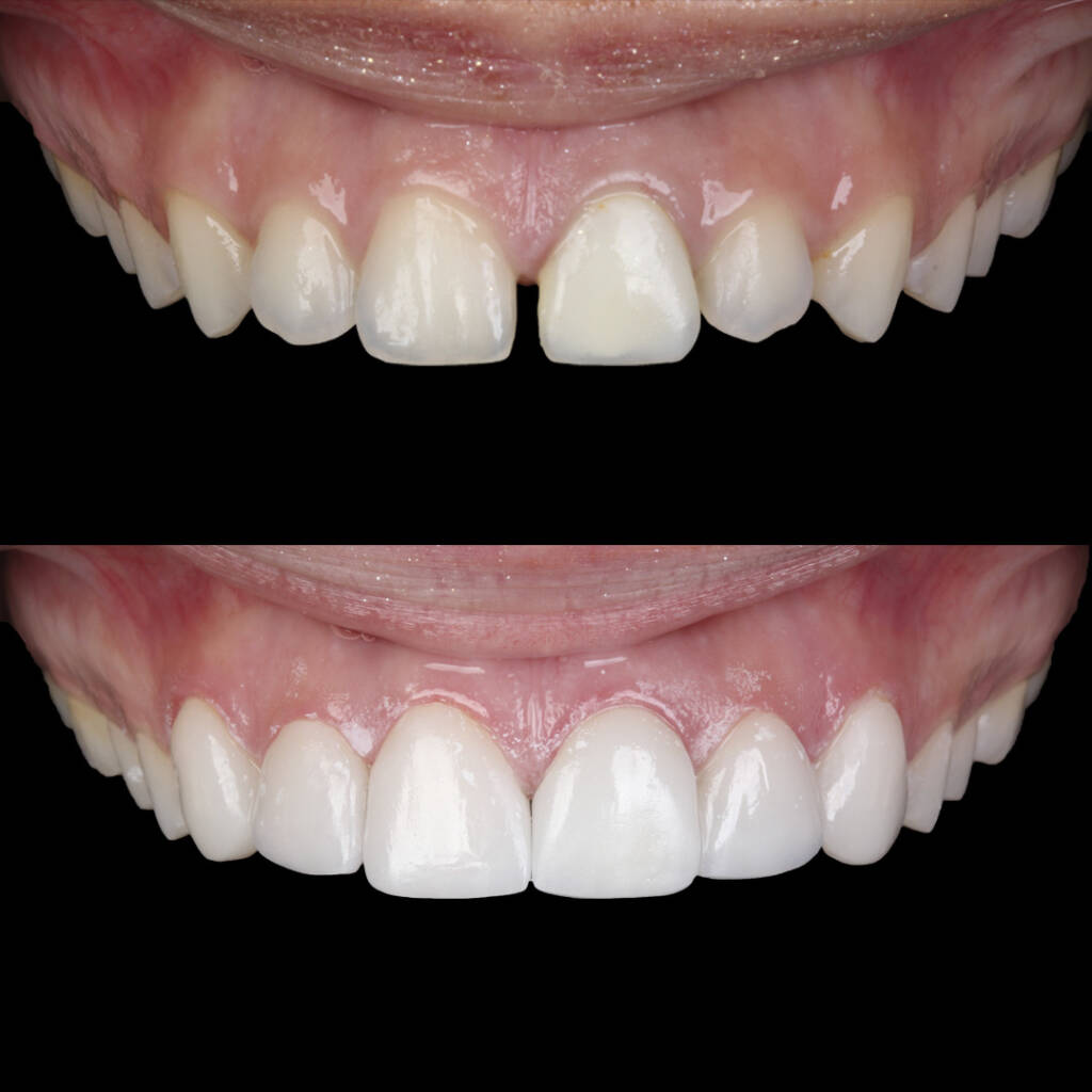 Lentes de porcelana na Allegra Odontologia Estética dental em SP
