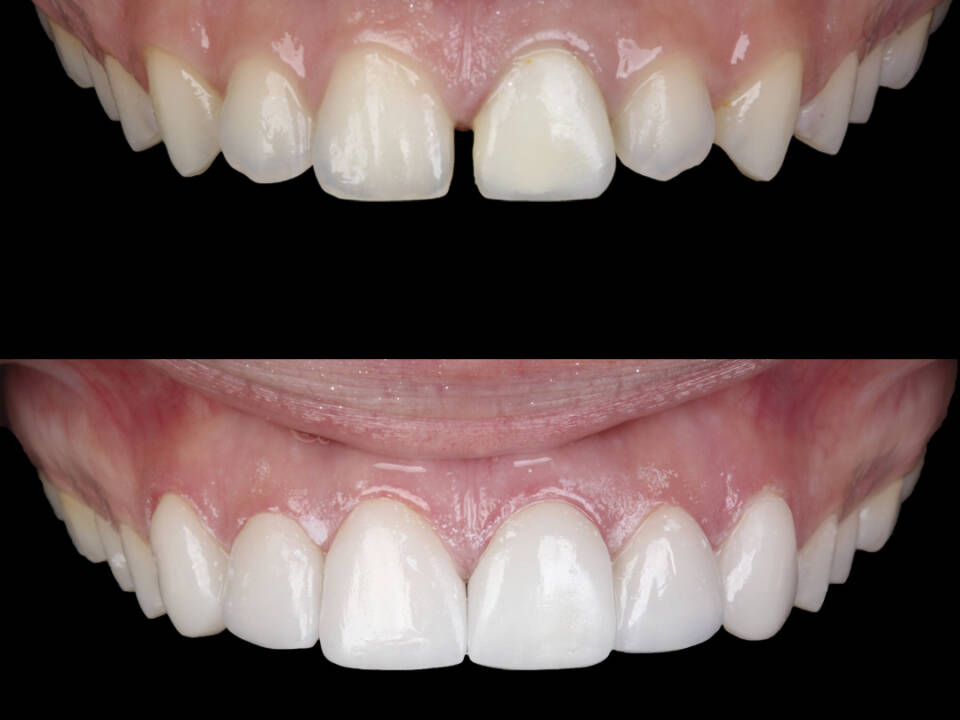 Lentes de porcelana na Allegra Odontologia Estética dental em SP
