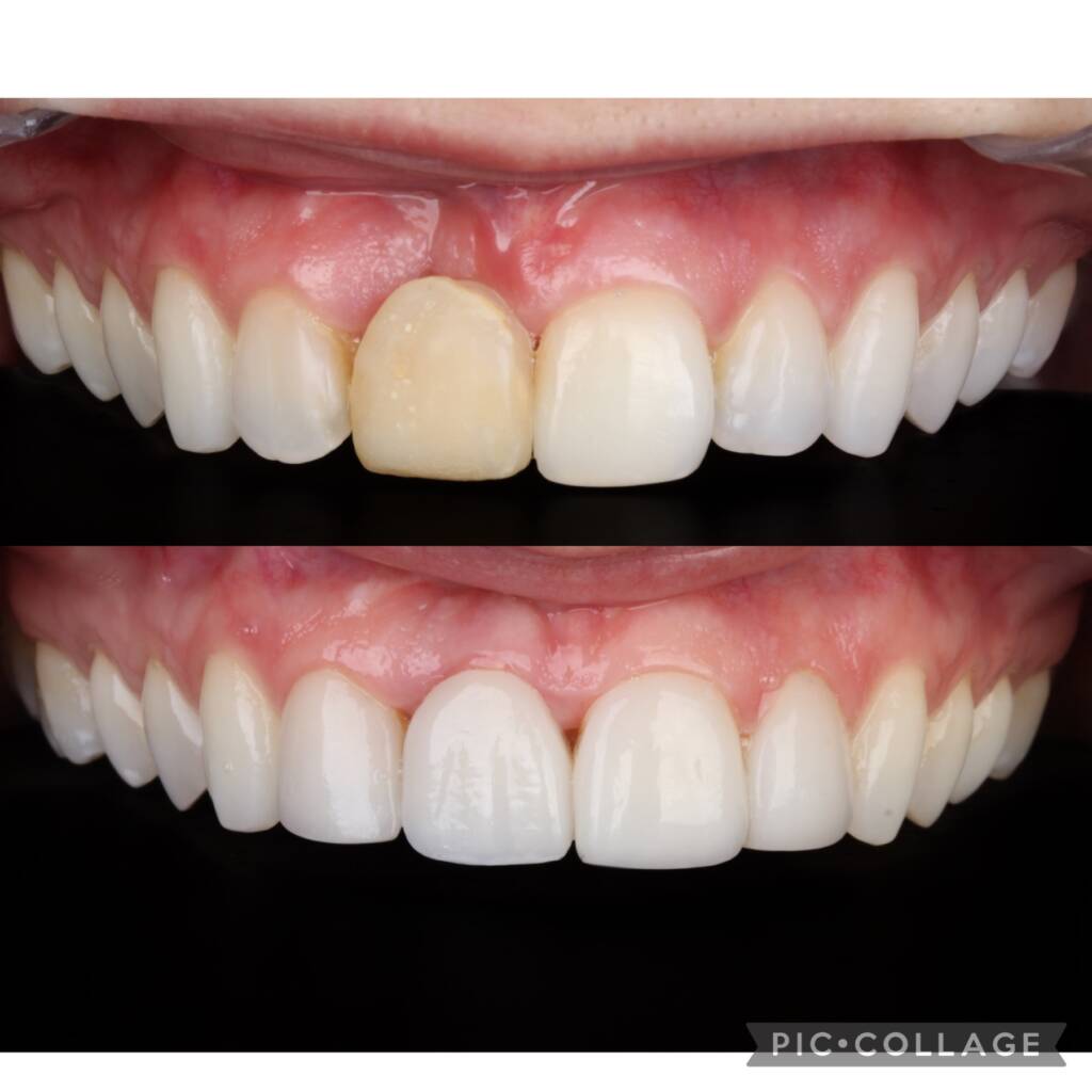 Implantes dentários na Allegra Odontologia