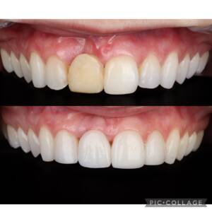Implantes dentários + coroa de porcelana na Allegra Odontologia - Estética dental perto do Brooklyn em SP