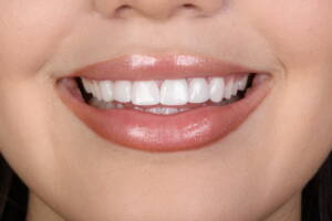 Lentes dentárias na Allegra Odontologia