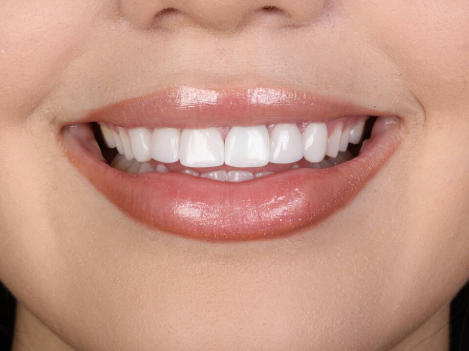 Lentes dentárias na Allegra Odontologia