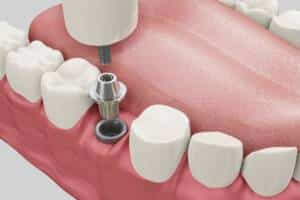 Implantes dentarios na Allegra Odontologia