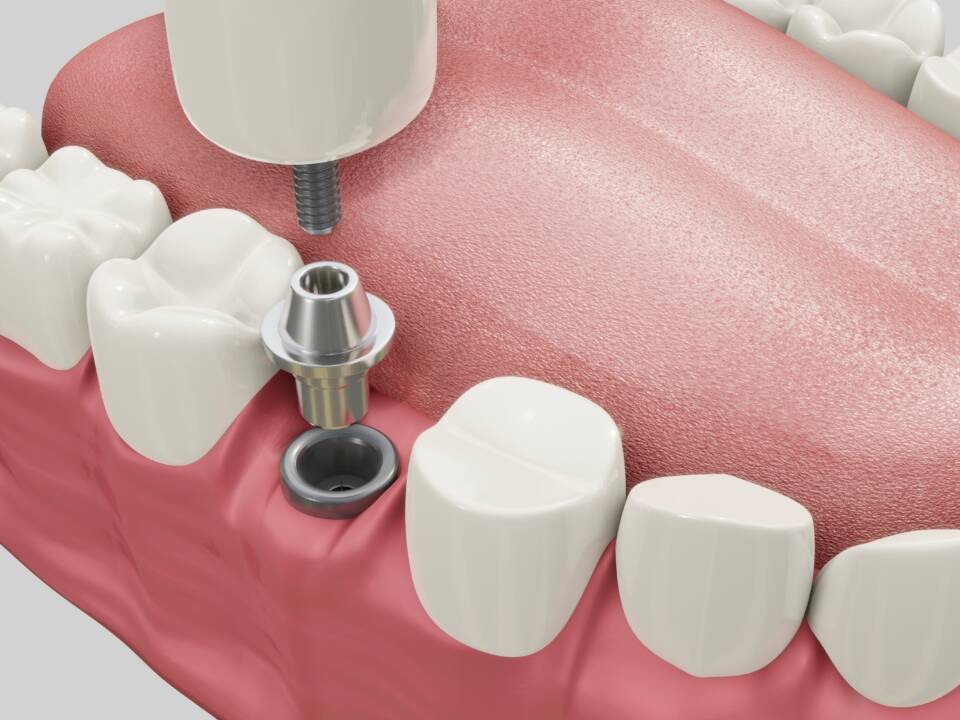 Implantes dentarios na Allegra Odontologia