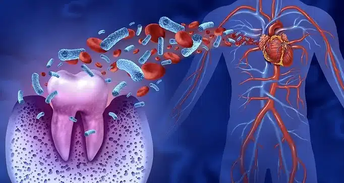 Endocarditis Animation Endocardite Bacteriana - Tudo que vocĂȘ precisa saber - Allegra Odontologia