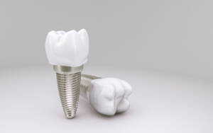 Implante de dente na Allegra Odontologia 