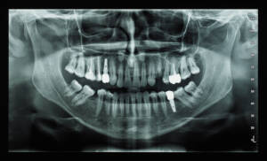 Raio x panoramico na Allegra Odontologia 
