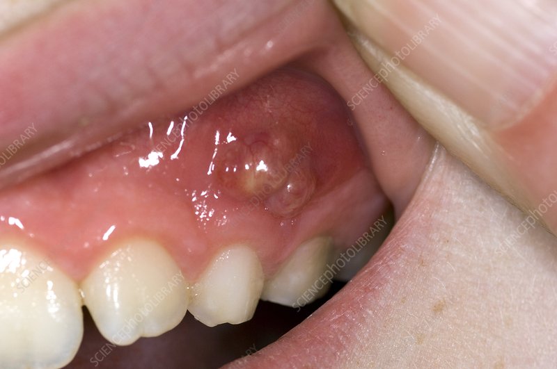 Abcesso dental com necessidade de um tratamento de canal - Allegra Odontologia