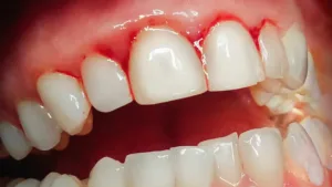 Gengiva avermelhada precisando de limpeza nos dentes proximo da Vila Prudente - Allegra Odontologia